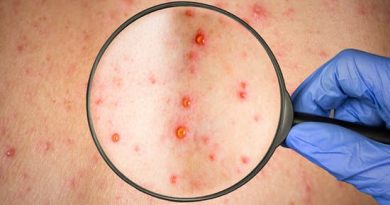 causa psicosomatica herpes zoster
