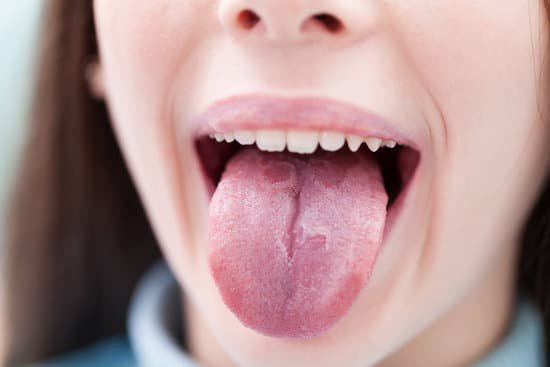 formicolio lingua e sclerosi multipla