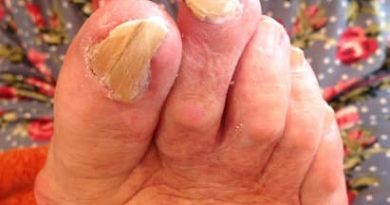 micosi delle unghie del piede