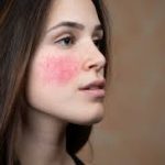 acne rosacea prima fase