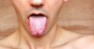 macchie bianche sulla lingua