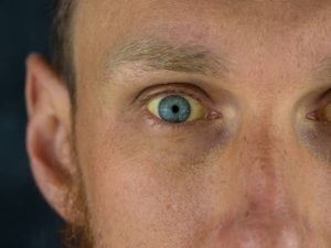 sindrome di gilbert e caffeina