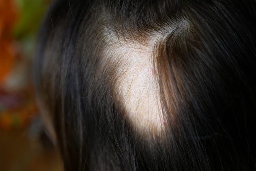 alopecia areata perdita capelli