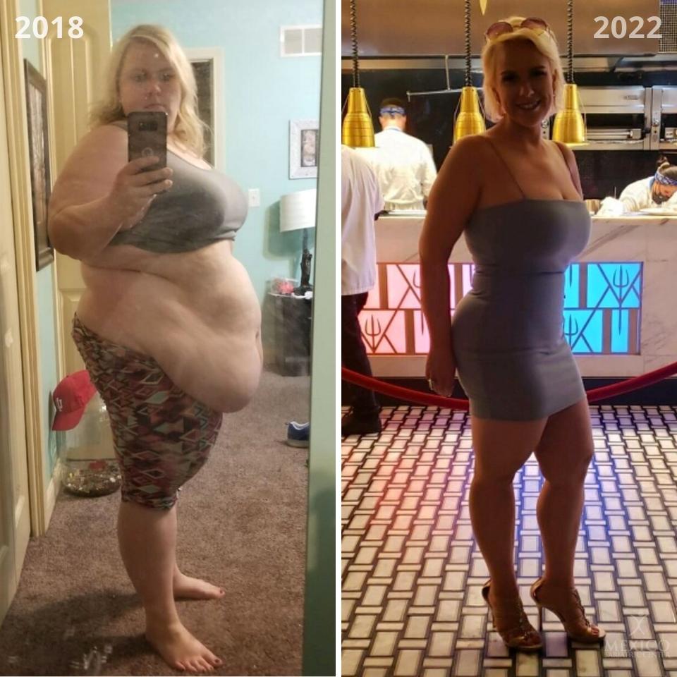 Prima e dopo sleeve gastrectomy 1