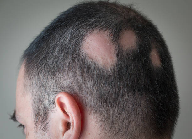 alopecia zoloft