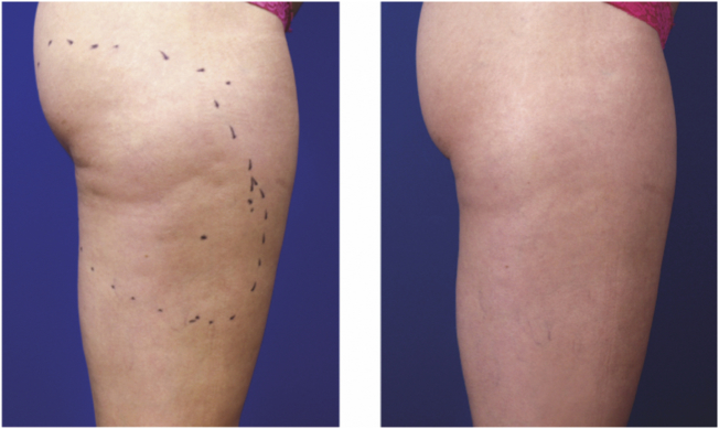 cellulite radiofrequenza prima e dopo trattamento