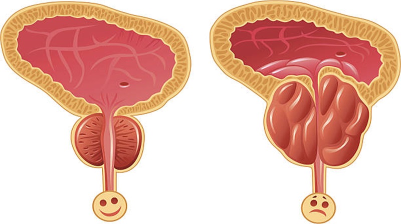 la prostata ingrossata può ostruire le feci
