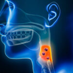 cancro laringe intelligenza artificiale