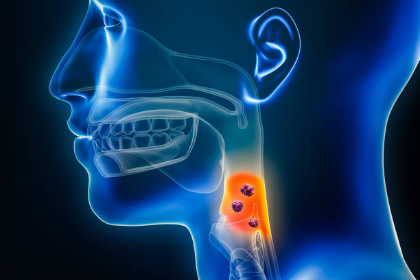 cancro laringe intelligenza artificiale