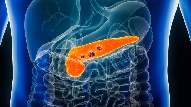 cancro pancreas